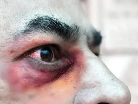 Bệnh nấm đen ở những bệnh nhân COVID-19