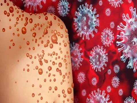 3 đối tượng có nguy cơ diễn tiến nặng khi mắc đậu mùa khỉ: Nhóm thứ 2 cần đặc biệt lưu tâm