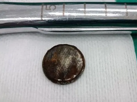 Tranh giành đồ chơi, bé gái 8 tuổi nuốt chửng pin cúc áo vào miệng