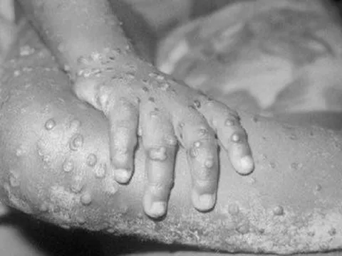 Bộ Y tế đề nghị các địa phương đẩy mạnh giám sát bệnh đậu mùa khỉ