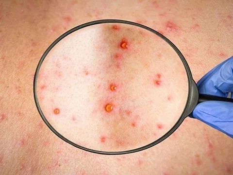 5 câu hỏi thường gặp về bệnh đậu mùa khỉ