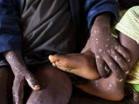 Châu Phi công bố 103 ca tử vong do đậu mùa khỉ, cảnh báo đường lây khác