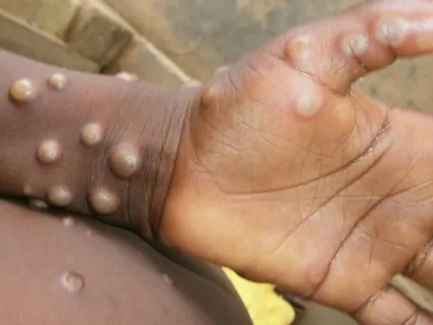 Làm sao để phát hiện nhanh chóng những dấu hiệu của bệnh đậu mùa khỉ?