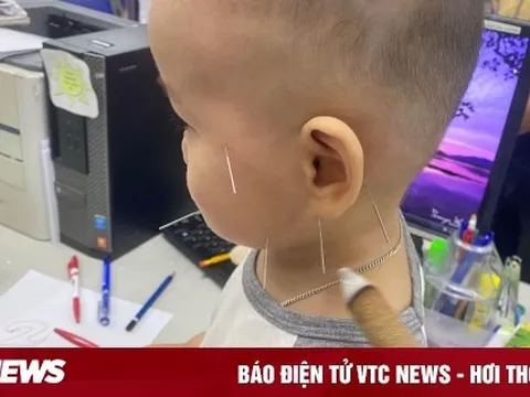 Bé 1 tuổi liệt mặt do nằm quạt