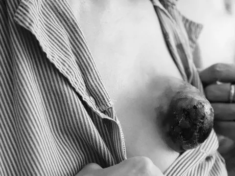 Tỉ lệ mắc ung thư mới tại Việt Nam tăng mạnh, có phải do môi trường sống?