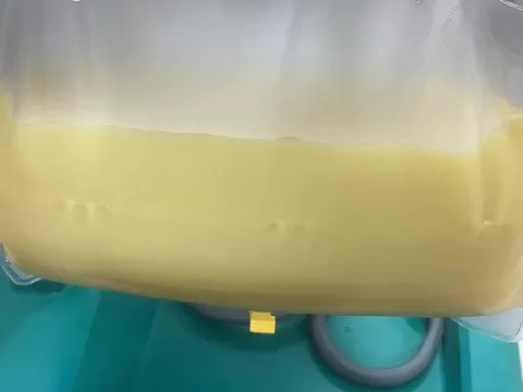 Cứu sống bệnh nhân có huyết tương trắng đục như sữa