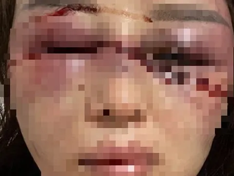 Công an vào cuộc vụ cán bộ QLTT đánh bạn gái dã man vì hát song ca với người khác