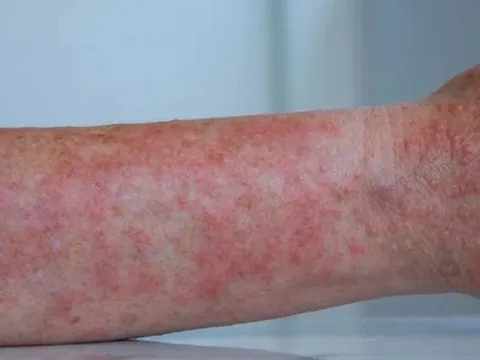 Mùa hè da dễ mẩn ngứa, vì sao?