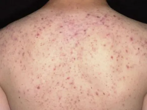 Người phụ nữ 36 tuổi suýt mất mạng vì đến spa trị mụn trứng cá ở lưng