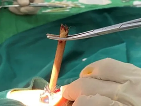 Cứu bệnh nhân nhập viện với cây đũa tre cắm sâu vào hốc mắt