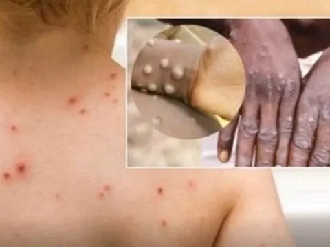 Thêm một nước phát hiện biến chủng đậu mùa khỉ mới