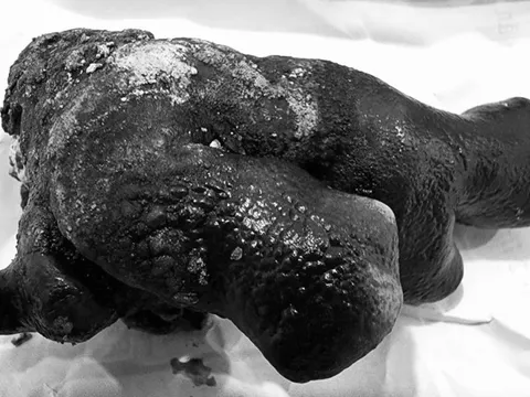 4 cách phòng ngừa sỏi thận