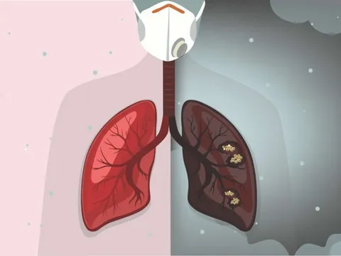 Chưa từng hút có thể ung thư phổi vì khói thuốc: "Thủ phạm" ẩn quanh mỗi người