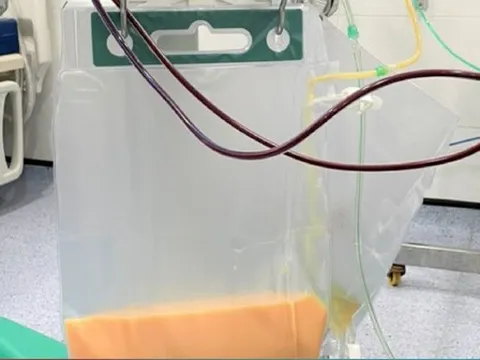 Cứu sống nữ bệnh nhân có huyết tương trắng đục như sữa