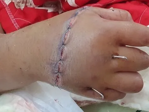 Thâu đêm nối thành công bàn tay phải bị đứt lìa của bé trai 12 tuổi