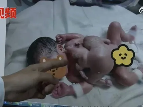 Bé sơ sinh 4 tay 4 chân vô cùng hiếm gặp