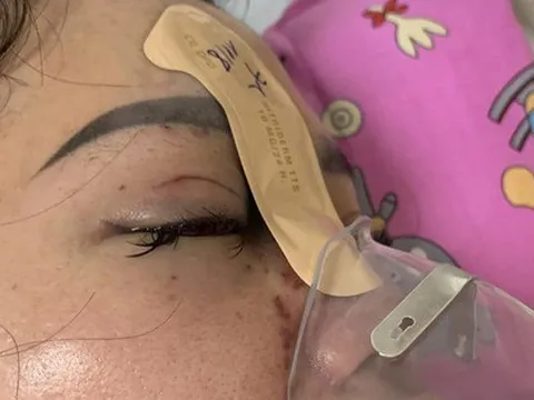 Mù mắt vì tiêm filler nâng mũi tại spa