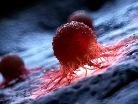 14 loại ung thư tăng cao toàn cầu: Do trẻ em học, chơi khuya, ăn vội?