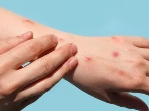 Bộ Y tế đề nghị tăng cường phòng, chống bệnh Đậu mùa khỉ