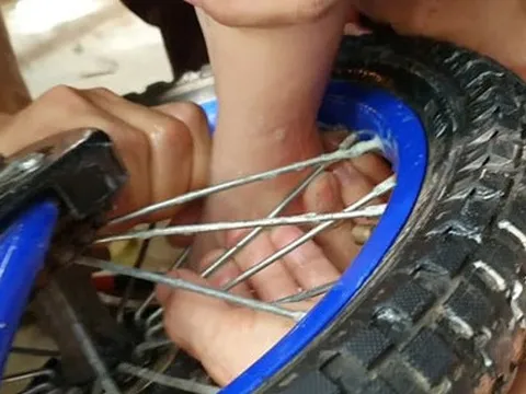 Bé gái 2 tuổi bị dập nát phần mềm gót chân do kẹt vào nan xe đạp