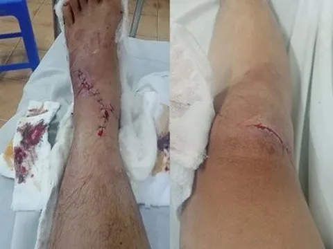 Điều tra vụ nam thanh niên bị truy sát suýt chết nghi ghen tuông