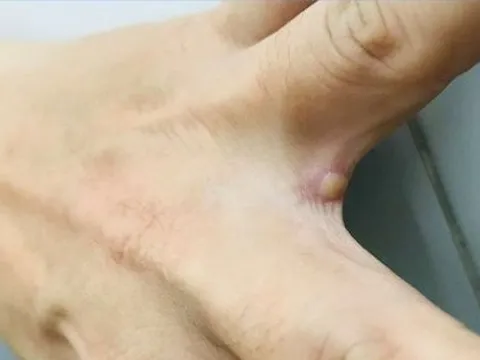 Vết mụn nước ở ca mắc đậu mùa khỉ tại Việt Nam có nguy hiểm? Chuyên gia lý giải