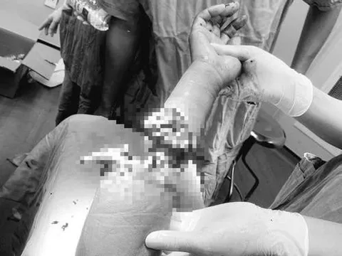 Nối cánh tay gần đứt lìa cho người phụ nữ bị cưa cắt