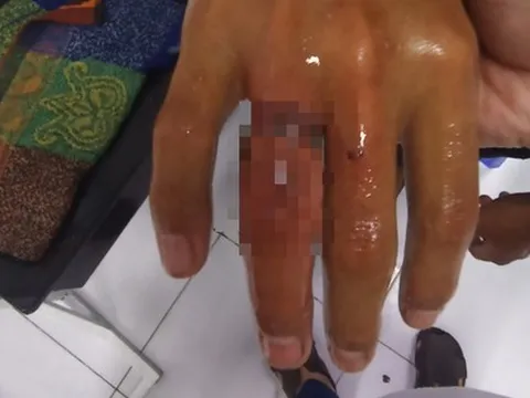 Suýt hoại tử ngón tay vì... đeo nhẫn