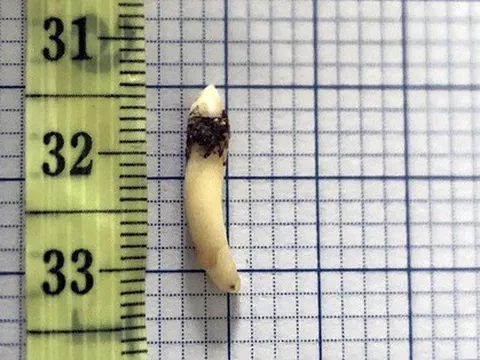 Đau đầu nhiều năm vì chiếc răng mọc ngược lên hốc mũi