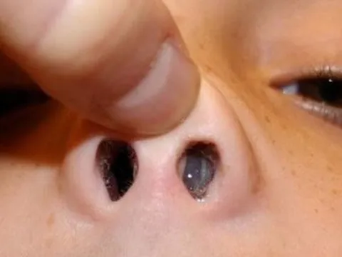 Ngạt tắc mũi tăng dần cảnh giác ung thư vùng mũi xoang