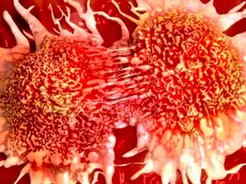 3 loại "ung thư hôn nhân": Khi một người mắc, nửa kia cần được tầm soát càng sớm càng tốt