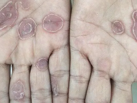 Sùi mào gà, giang mai, lậu... lây qua đường tình dục tăng, rất phổ biến ở giới trẻ