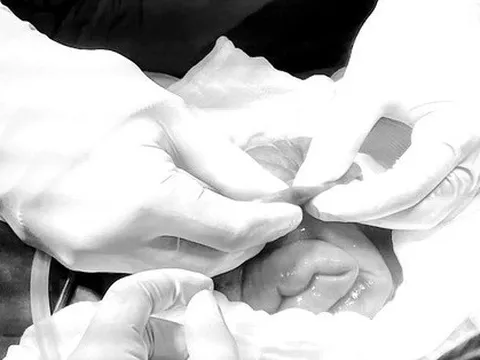 Cứu thiếu niên bị chảy máu thành vòi trong lòng ruột non