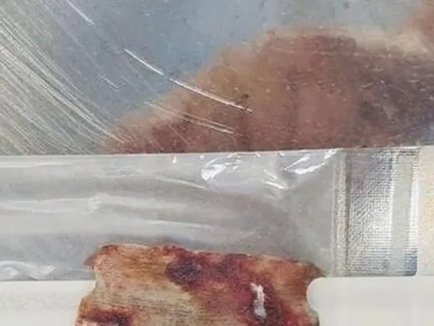 Thanh Hoá: Người đàn ông ruột lòi ra ngoài vì lưỡi cưa cắm ngập ổ bụng