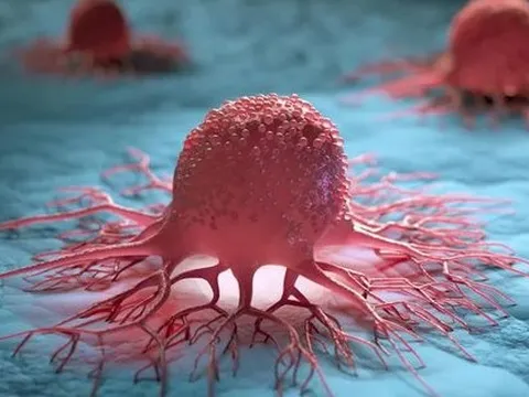 Đột phá: Phát hiện thứ có thể khiến ung thư ngừng di căn