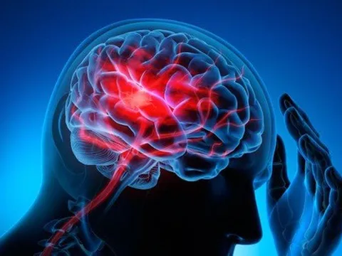 Đàn ông Việt Nam bị đột quỵ cao hơn nữ 2,5 lần, trái ngược nước ngoài