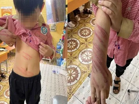 Hải Phòng: Điều tra việc bé trai 8 tuổi bị bạn trai của mẹ bạo hành