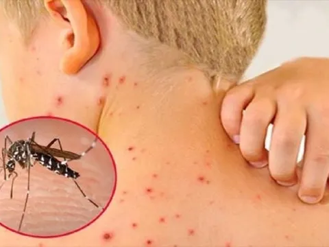 Chuyên gia chỉ ra những điều cần làm để phòng bệnh sốt xuất huyết