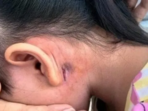 Chủ động phòng bệnh Whitmore