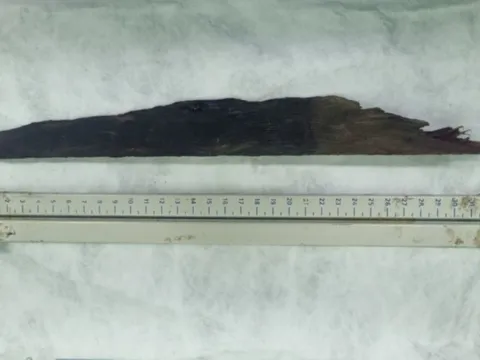 Phẫu thuật cứu sống bệnh nhân bị dị vật đâm xuyên ngực nguy kịch