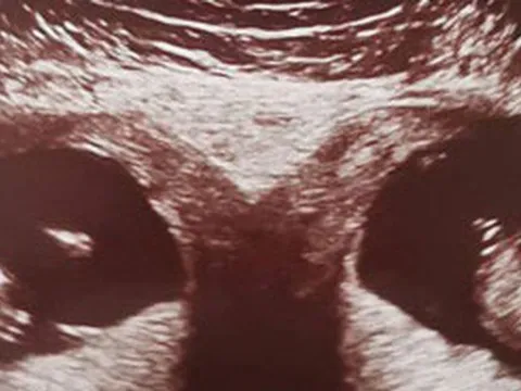 Hiếm gặp: Sản phụ mang thai đôi ở hai tử cung khác nhau