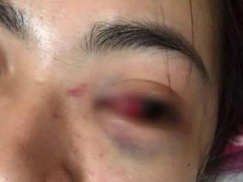 Hà Tĩnh: Điều tra vụ nữ sinh bị bạn đánh hội đồng tụ máu mắt