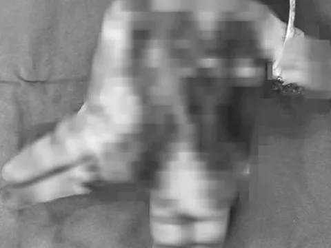 Thiếu niên 14 tuổi nát bàn tay do nổ điện thoại