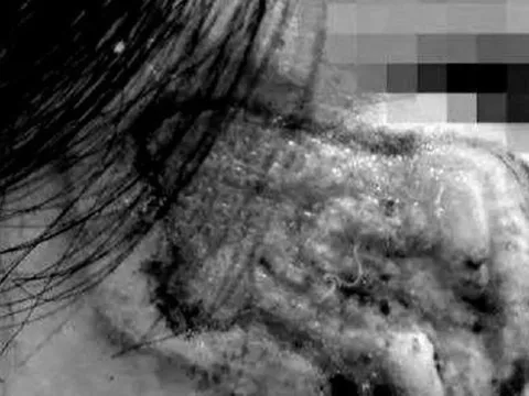 Ham rẻ, quý bà biến dạng mặt vì làm đẹp bằng "thuốc chứa axit”