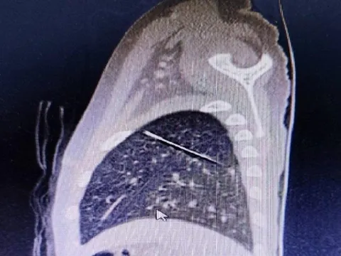 Hi hữu: Kim may quần áo đi lạc nằm sâu trong phổi bé 4 tuổi