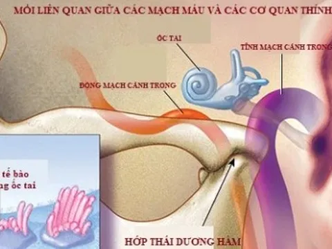 Ù tai có thể là chỉ dấu báo trước về bệnh tim mạch nguy hiểm