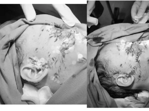 Thương tâm bé trai 2 tuổi bị chó cắn trọng thương vùng đầu, mặt