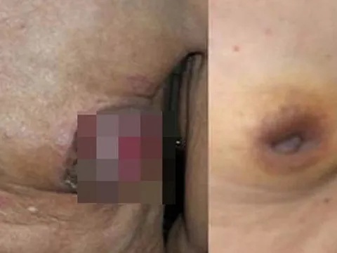 Nam giới cũng bị ung thư vú?