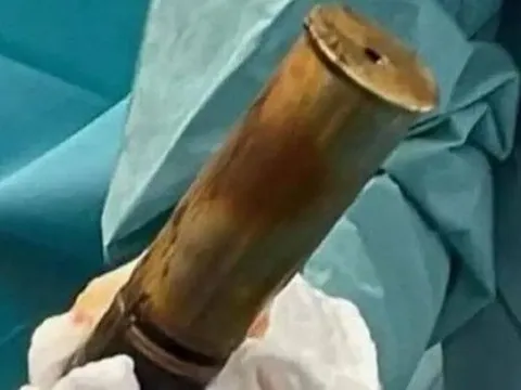 Bệnh viện sơ tán khi cấp cứu bệnh nhân bị kẹt đạn pháo trong hậu môn