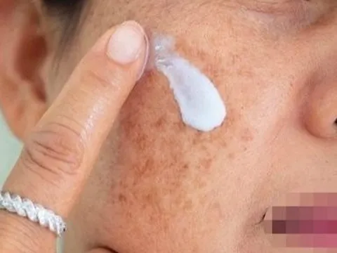 Phát hiện kem chuyên nám không rõ nguồn gốc, nghi hàng giả